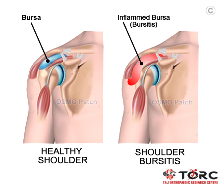 What is Shoulder Bursitis?