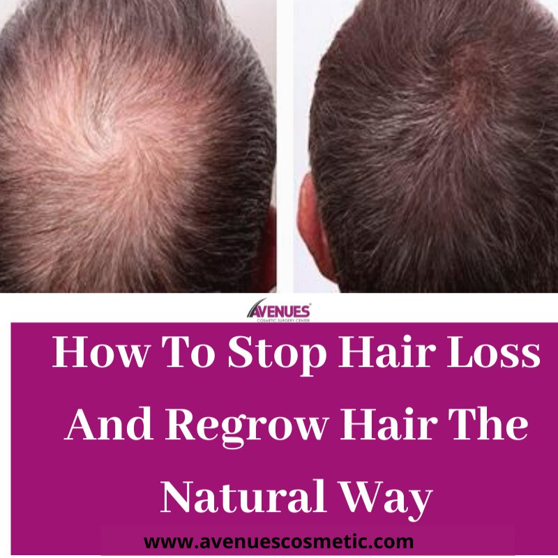 Hair Treatment in Ahmedabad | Hair Clinic in Ahmedabad