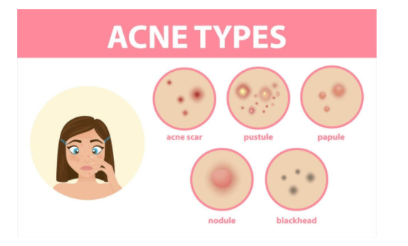 Tips for Acne Scar Skin Care