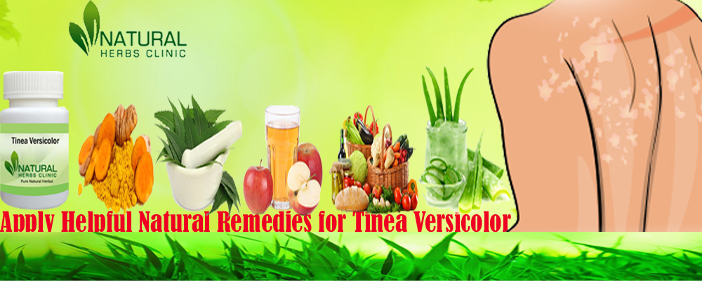 Apply Helpful Natural Remedies for Tinea Versicolor