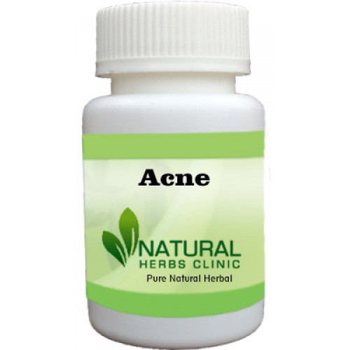 Herbal Treatment for Acne | Natural Remedies | Natural Herbs Clinic