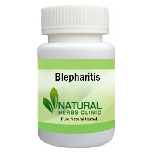Herbal Treatment for Blepharitis - Natural Herbs Clinic