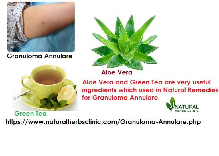 Natural Remedies for Granuloma Annulare, Let’s Describes Some