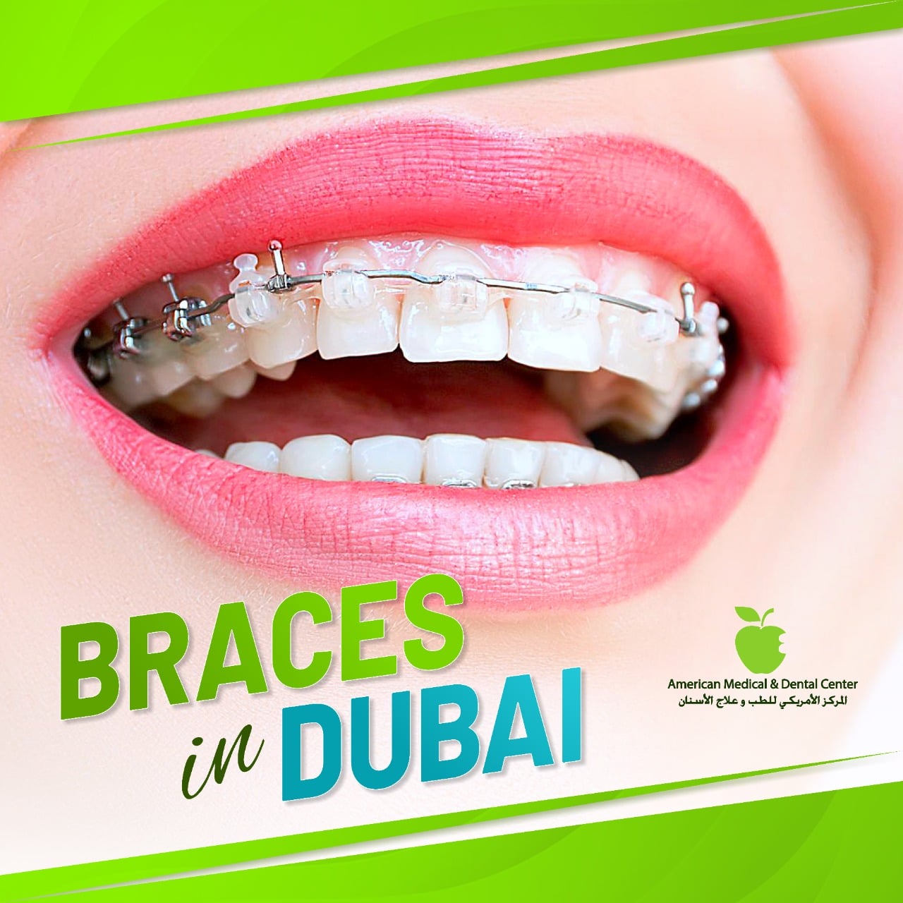 Best Braces Dentist in Dubai