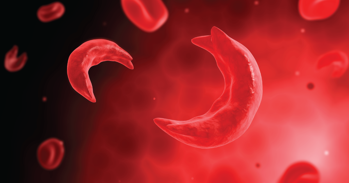 Sickle Cell Anemia Market Size, Drivers, Restraints Challenges, and Growth Opportunities Till 2028