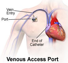 Totally Implantable Access Port Market Outbreak: Key Trends, Growth, Insights and Forecast to 2027