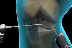 Corona Virus Outbreak : Arthroscopy Devices Market Research Report Forecast and Opportunities Till 2027