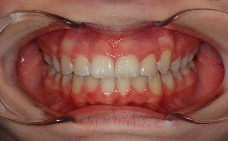 Clear aligner solutions for modern smile correction