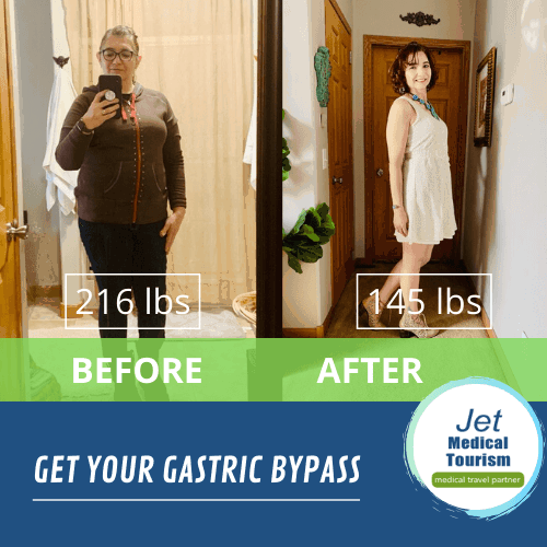 Gastric Bypass Before and After Pictures