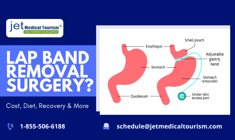 What is Lap Band Removal Surgery | Lap Band Removal Cost & Recovery