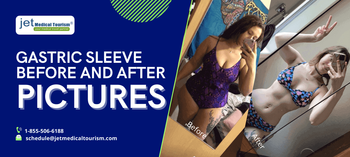 Gastric Sleeve Reviews