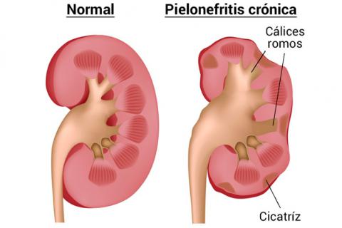 Pielonefritis complicaciones
