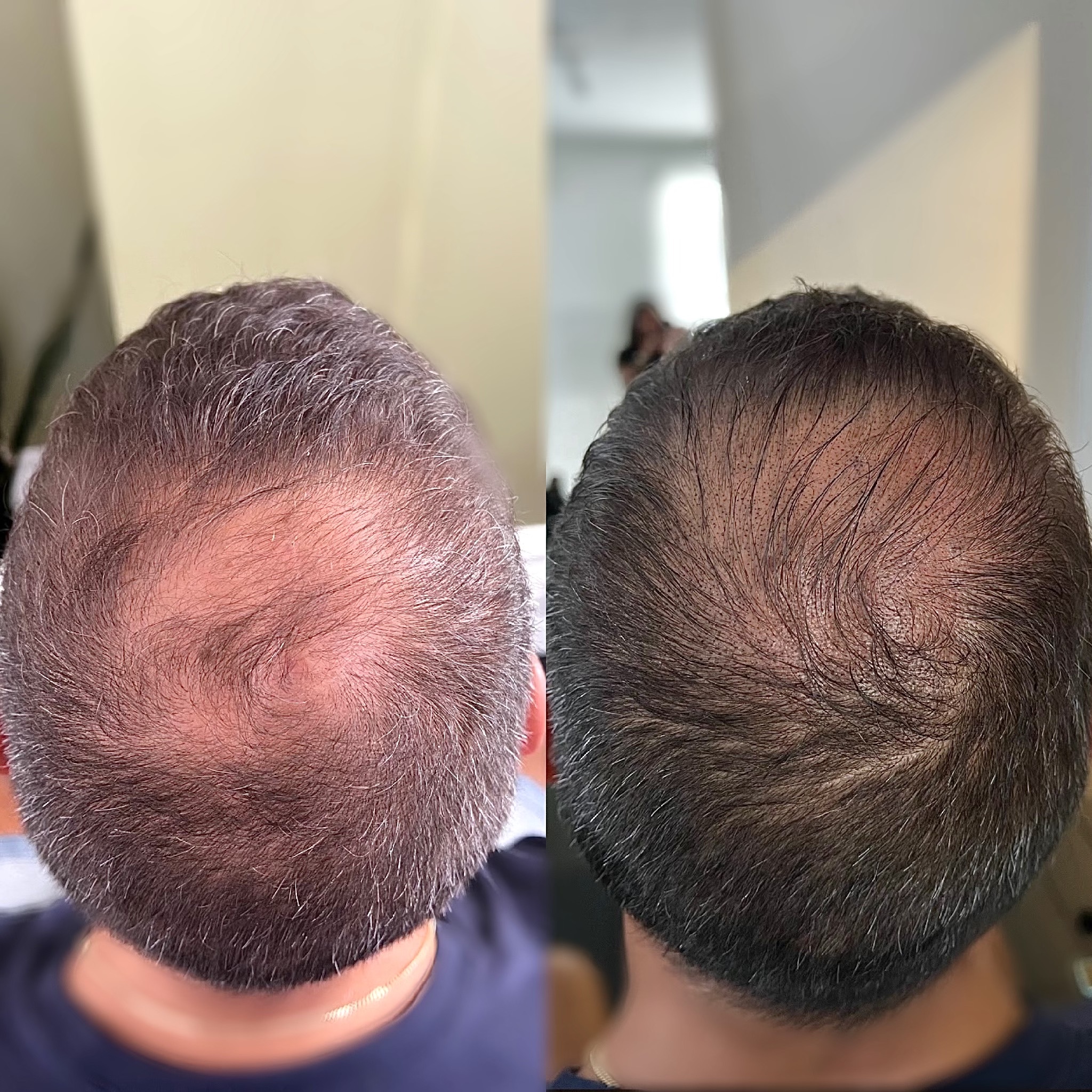  8 Things You Must Know About Scalp Micropigmentation