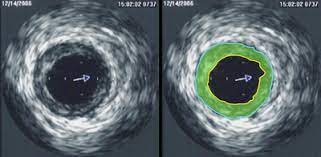 Intravascular Ultrasound Market Size, Share, Growth Opportunity & Global Forecast to 2027