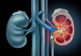Cystinuria Treatment Market Size, Growth & Global Forecast Report to 2027