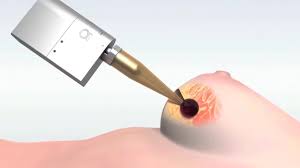 Intraoperative Radiation Therapy Market 2020 | Industry Demand, Fastest Growth, Opportunities Analysis and Forecast To 2027