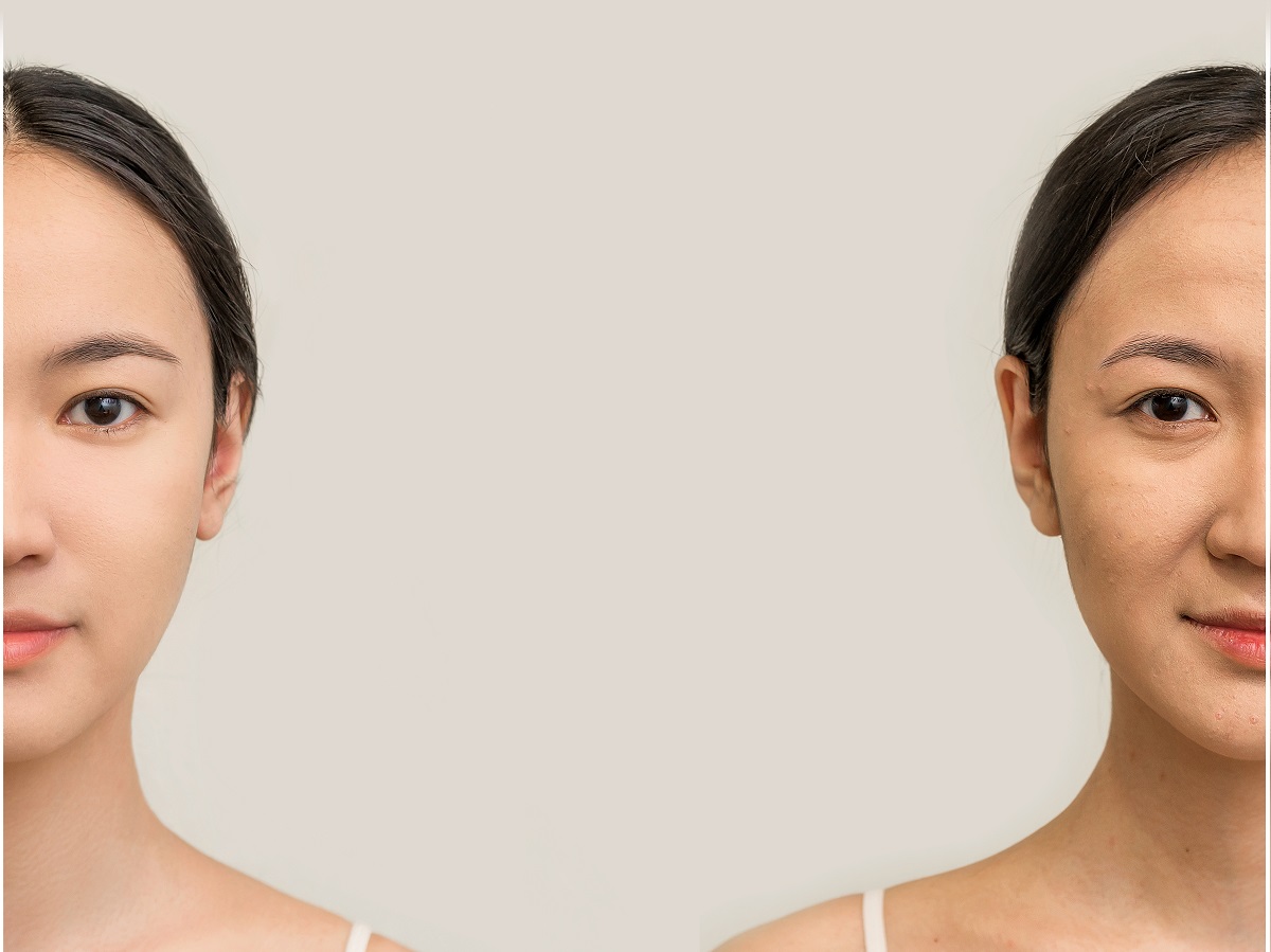 Here's How You Can Aid Scars Naturally!