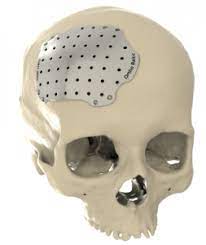 Cranial Implants Treatment Market 2020 Size, Growth Factors & Forecast Report to 2027