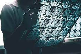 Global Rare Neurodegenerative Disease Treatment Market Report, Latest Trends, Industry Opportunity & Forecast to 2027