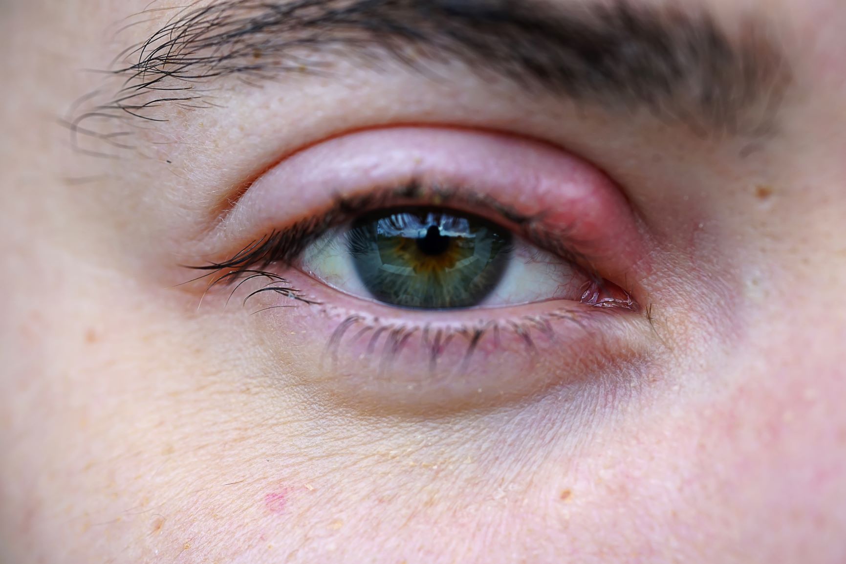 What Are Eye Styes?