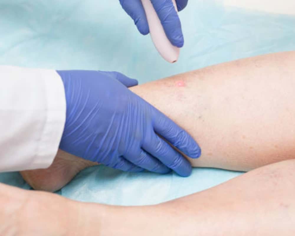 How To Prevent Varicose Veins?
