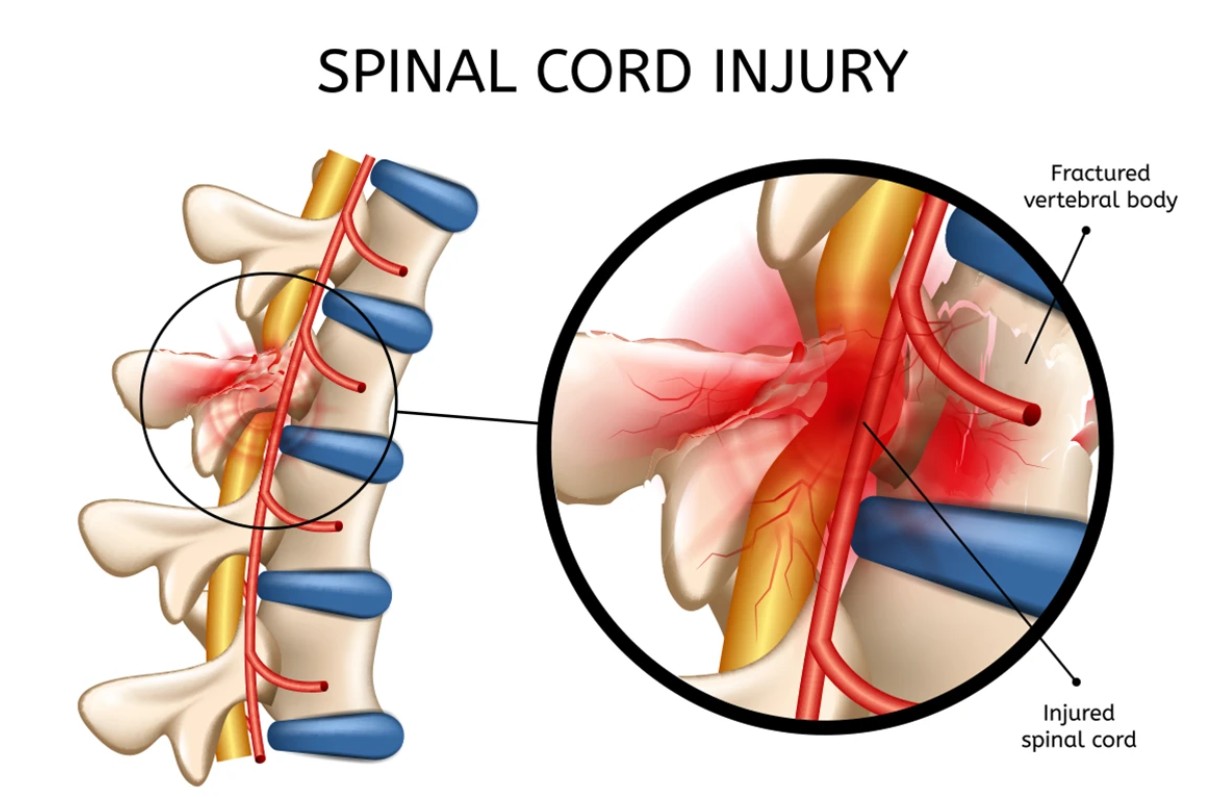 Spinal Cord Injury Stem Cell Therapy: A Hopeful Frontier in Regenerative Medicine