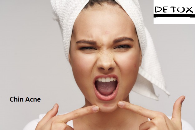 Chin Acne - Cure Adult Acne