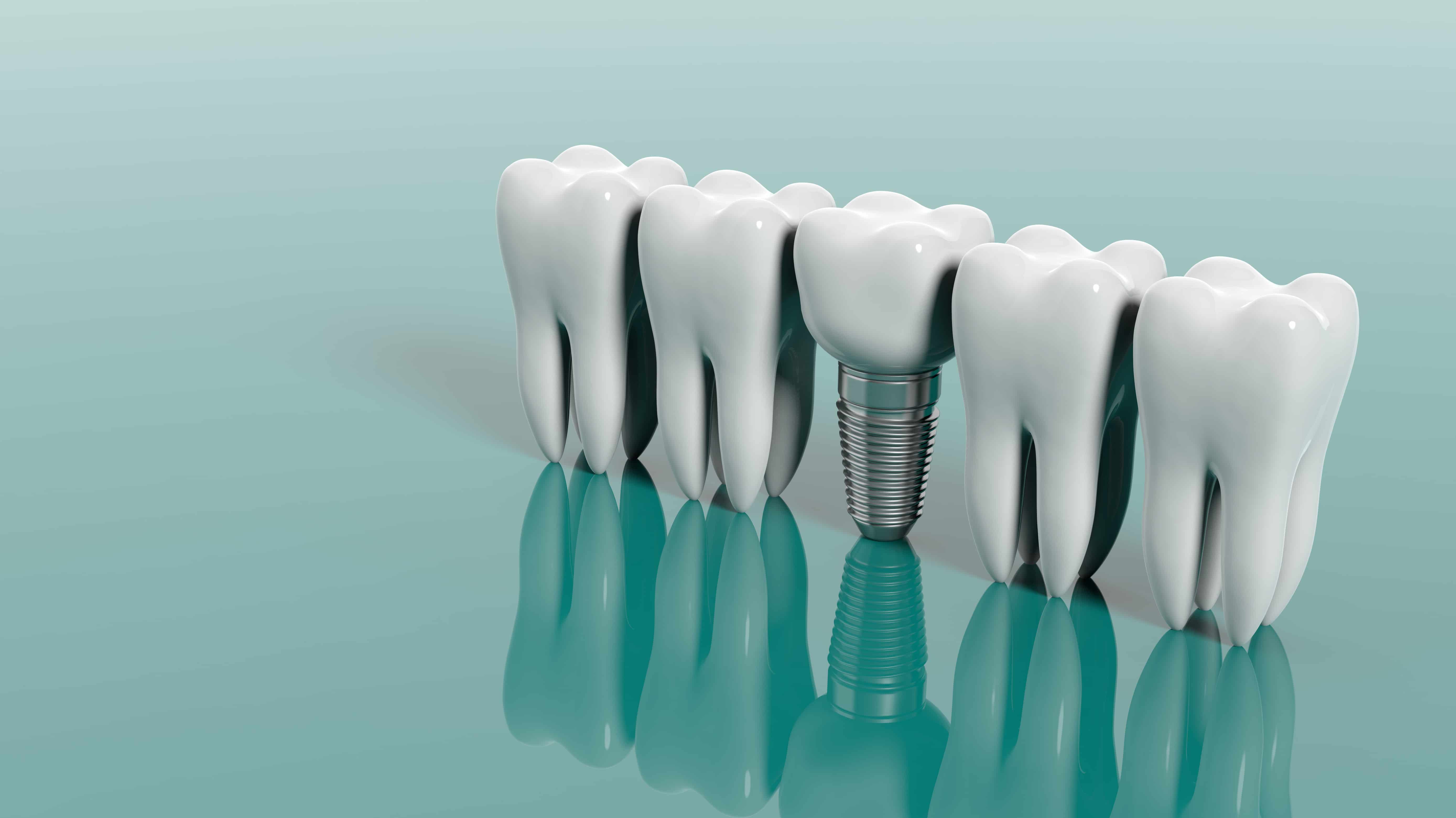 The Role Of Crown And Bridge Dental Labs In Restoring Oral Health