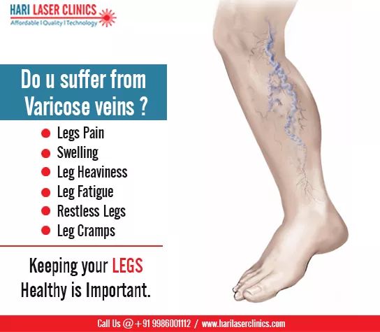 Varicose Veins Prevention