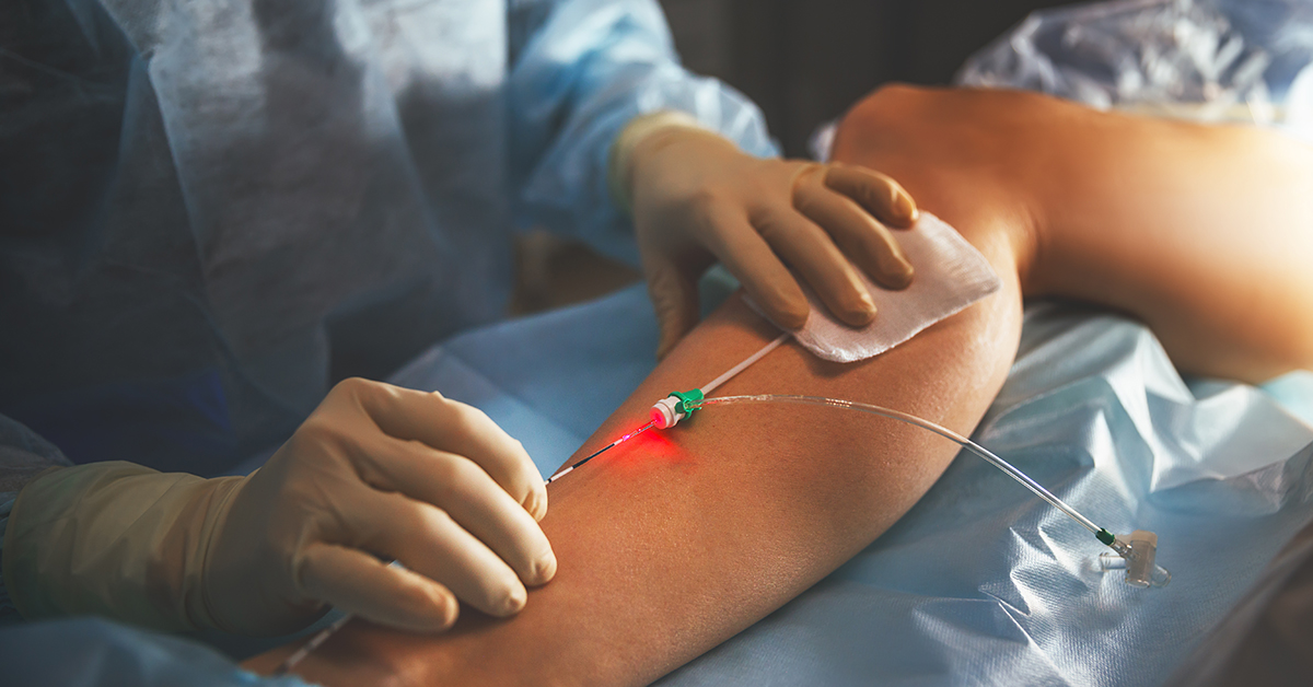 How Effective Is Laser Treatment For Varicose Veins?