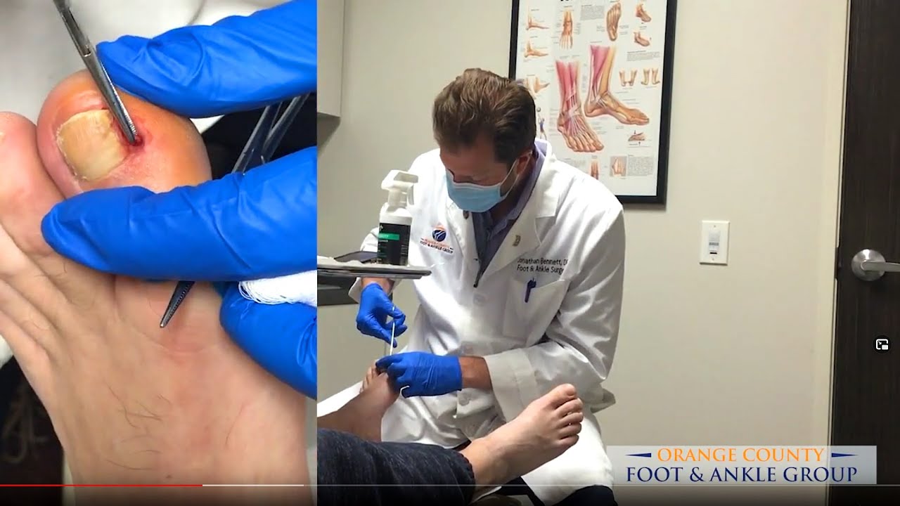 What are ingrown toenails?