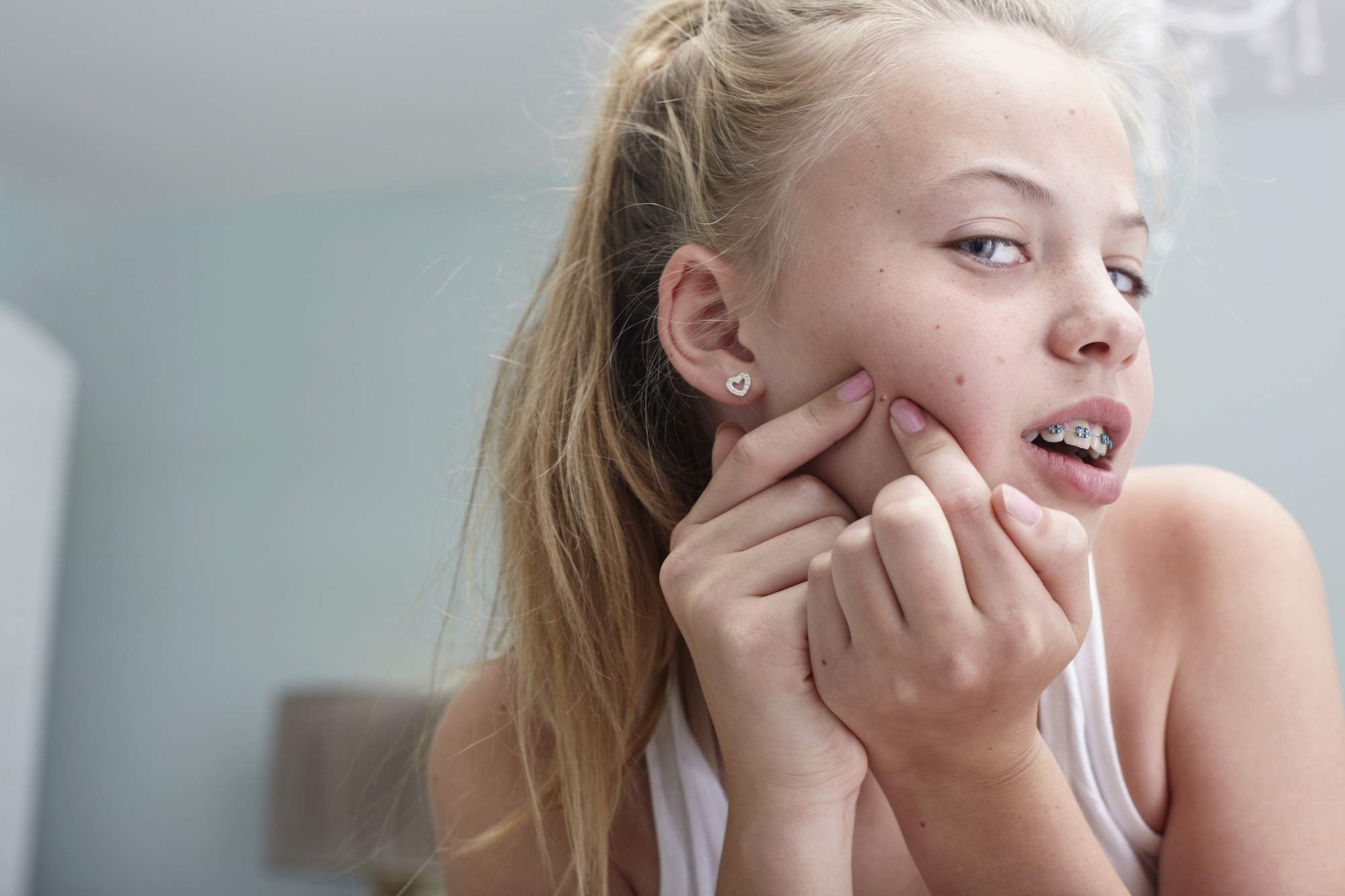 Treat Your Teenage Acne Naturally and Effectively