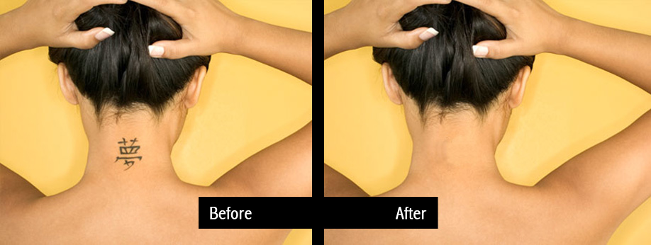 Best Laser Tattoo Removal Birmingham, UK