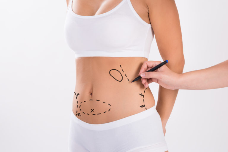 Liposuction Fibrosis Treatment- Aspen After Surgery Centers