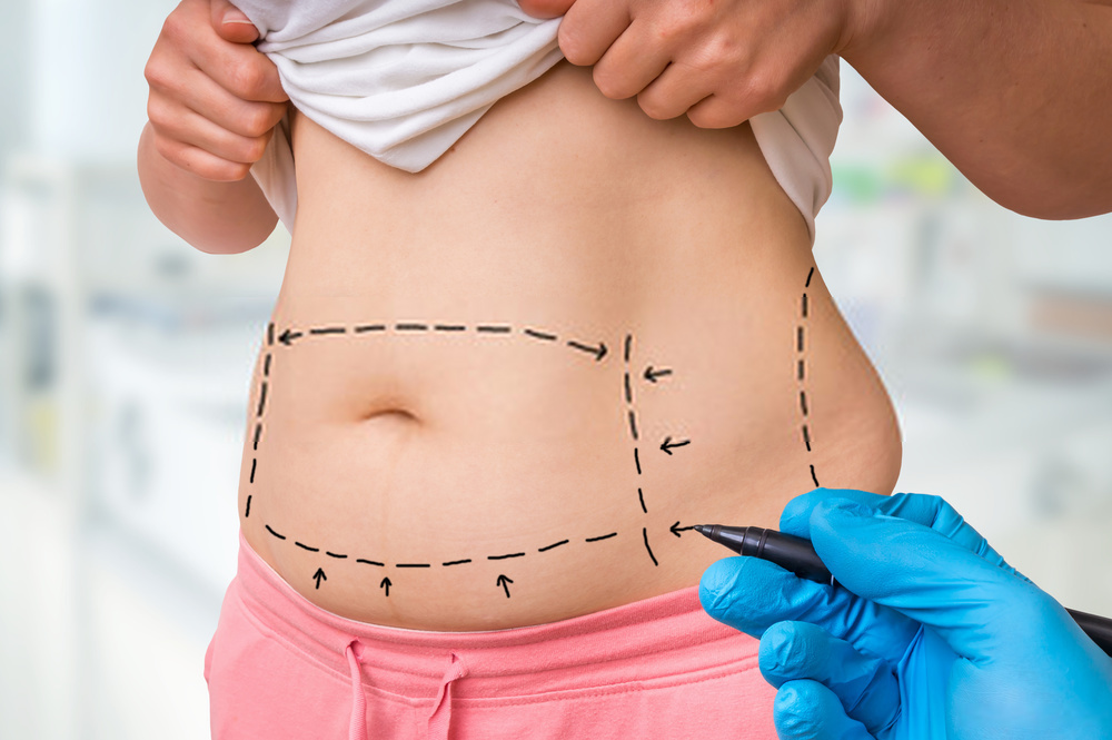 Tummy Tuck Treatment Options For Mommy