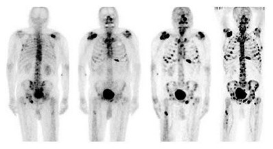 Prostate Cancer in Cape Town