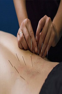 Book Appointment with Best Dry Needling Therapist
