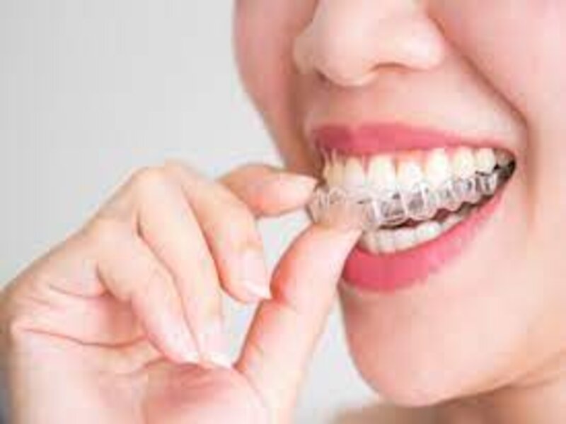How Long Does Invisalign Hurt - Dental Movemints