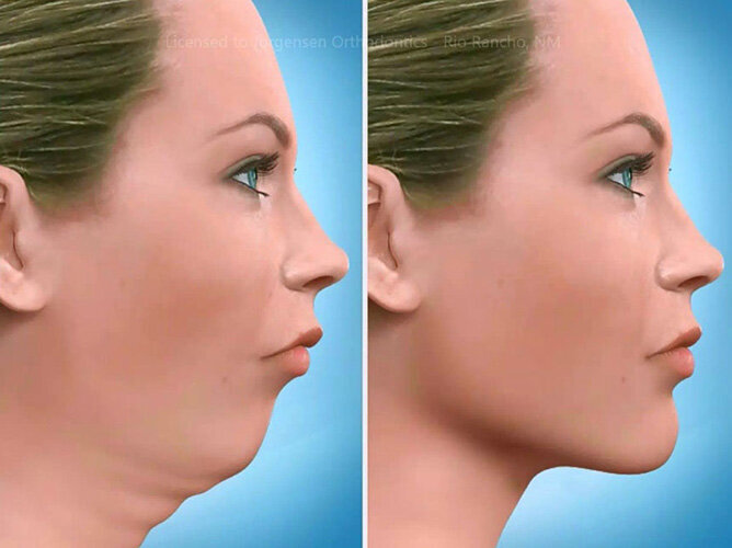 Orthognathic Surgery
