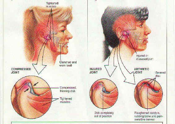TMJ Disorder Treatment