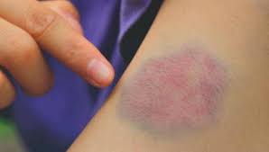 What is a blood clot?