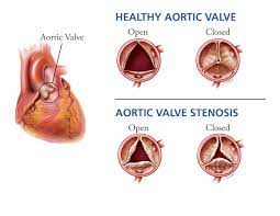 prosthetic heart valves