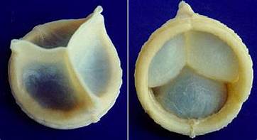 Heart Valve Disease