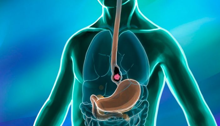 Esophageal Cancer Market Economic Trends, Industry Development, Challenges, Forecast and Strategies To 2027