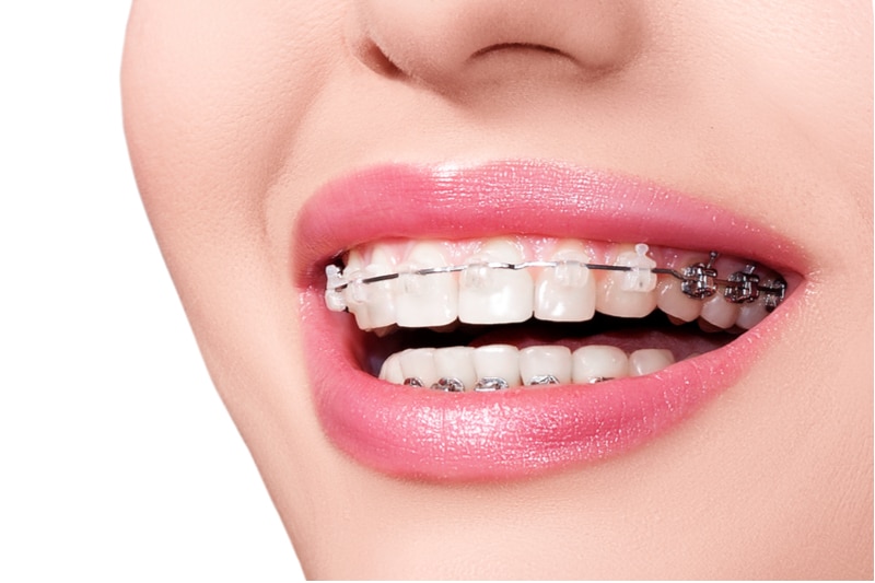 Best Orthodontic Treatment to get a perfect smile