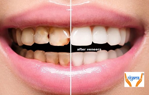 Dental Veneers: Procedure, Benefits and Cost