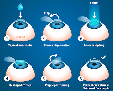 Lasik Surgery in Ghaziabad