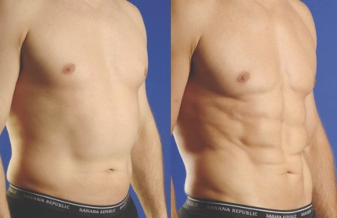 7 Reasons Why Men Should Go For Body Sculpting Treatment For Toned Body