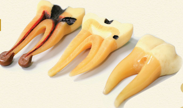 Root canal treatment in anna nagar Chennai