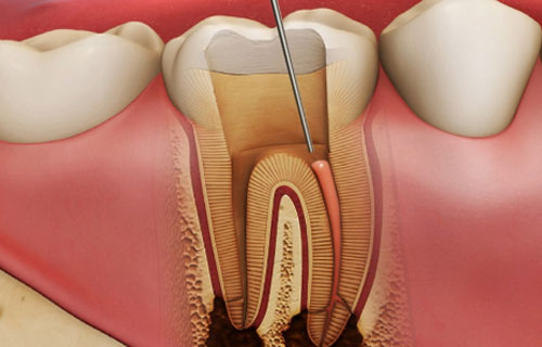 Root Canal Treatment: Painless and Single Visit Way 